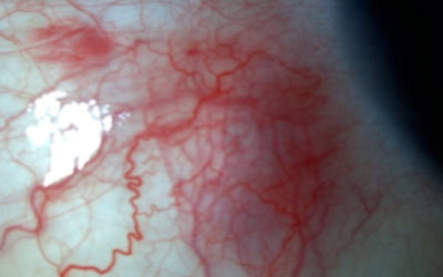 Escleritis Anterior Nodular