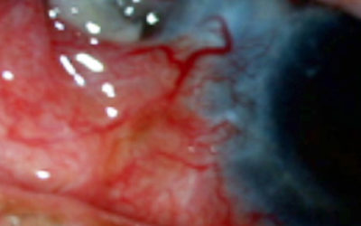 Esclerítis anterior necrotizante con inflamación