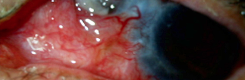 Esclerítis anterior necrotizante con inflamación