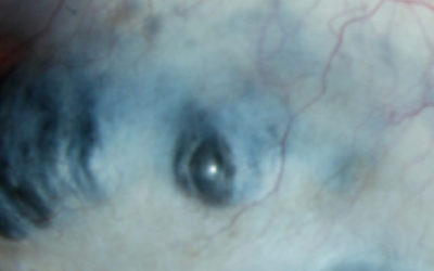 Esclerítis anterior necrotizante sin inflamación (Escleromalacia Perforans)