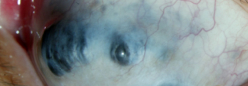 Esclerítis anterior necrotizante sin inflamación (Escleromalacia Perforans)