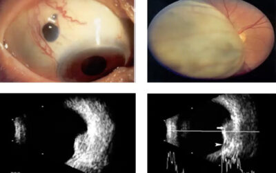 Angiografia Fluoresceínica