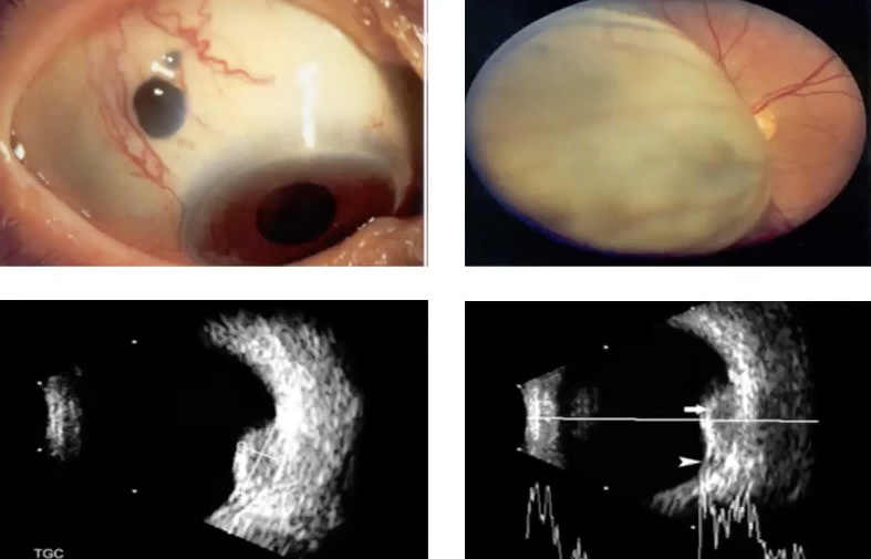 Angiografia Fluoresceínica